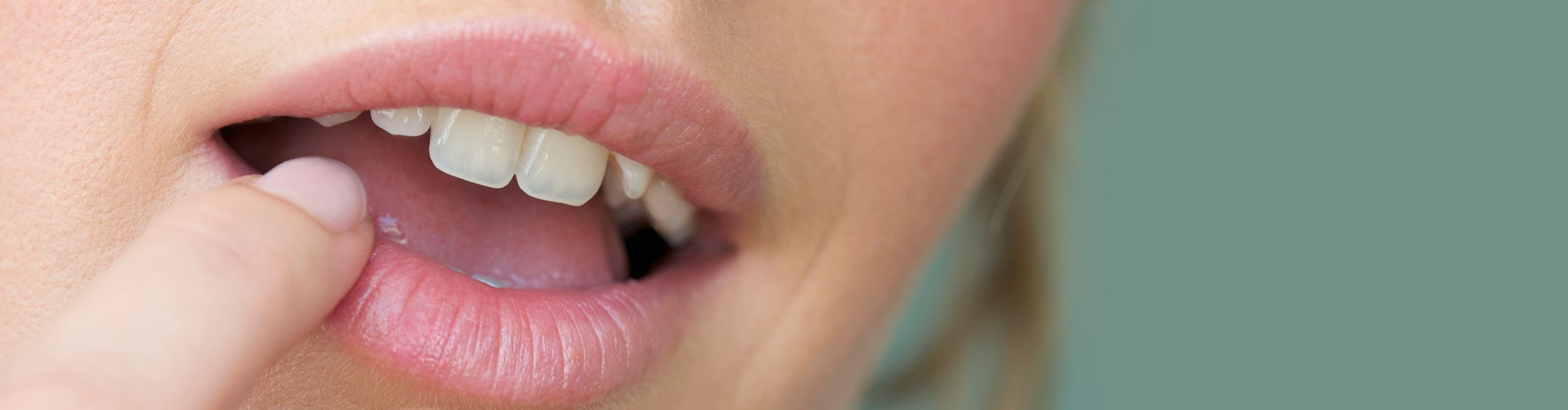Herpes labial